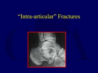 “Intra-articular” Fractures
 