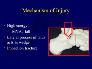 Mechanism of Injury
• High energy:
─ MVA, fall
• Lateral process of talus
acts as wedge
• Impaction fracture
 