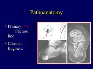 Pathoanatomy
• Primary
fracture
line
• Constant
fragment
 