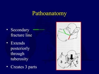 Pathoanatomy
• Secondary
fracture line
• Extends
posteriorly
through
tuberosity
• Creates 3 parts
1
2
3
 
