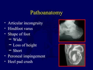 Pathoanatomy
• Articular incongruity
• Hindfoot varus
• Shape of foot
─ Wide
─ Loss of height
─ Short
• Peroneal impingement
• Heel pad crush
 