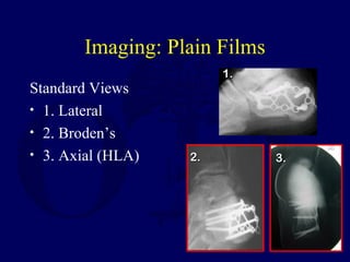 Imaging: Plain Films
Standard Views
• 1. Lateral
• 2. Broden’s
• 3. Axial (HLA)
1.1.
3.3.2.2.
 