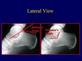 Lateral View
Bohler’sBohler’s
AngleAngle Gissane’sGissane’s
AngleAngle
 