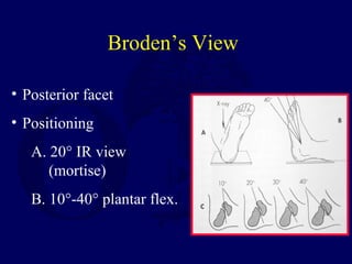 Broden’s View
• Posterior facet
• Positioning
A. 20° IR view
(mortise)
B. 10°-40° plantar flex.
 