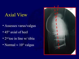 Axial View
• Assesses varus/valgus
• 45° axial of heel
• 2nd
toe in line w/ tibia
• Normal ≈ 10° valgus
 