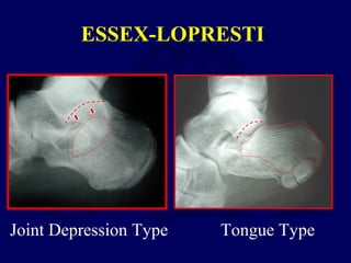 ESSEX-LOPRESTI
Joint Depression Type Tongue Type
 