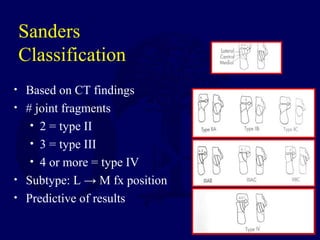 Sanders
Classification
• Based on CT findings
• # joint fragments
• 2 = type II
• 3 = type III
• 4 or more = type IV
• Subtype: L → M fx position
• Predictive of results
 