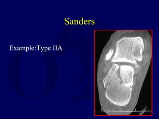 Sanders
Example:Type IIA
 