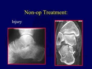 Non-op Treatment:
Injury
 