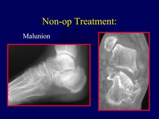 Non-op Treatment:
Malunion
 