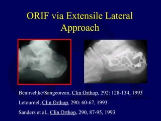 ORIF via Extensile Lateral
Approach
Benirschke/Sangeorzan, Clin Orthop, 292: 128-134, 1993
Letournel, Clin Orthop, 290: 60-67, 1993
Sanders et al., Clin Orthop, 290, 87-95, 1993
 