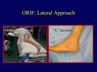 ORIF: Lateral Approach
• Lateral decubitusLateral decubitus • ““L” incisionL” incision
 
