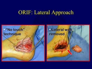 ORIF: Lateral Approach
• ““No touch”No touch”
techniquetechnique
• Lateral wallLateral wall
removedremoved
 