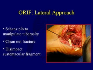 ORIF: Lateral Approach
• Schanz pin to
manipulate tuberosity
• Clean out fracture
• Disimpact
sustentacular fragment
 