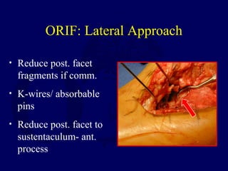 ORIF: Lateral Approach
• Reduce post. facet
fragments if comm.
• K-wires/ absorbable
pins
• Reduce post. facet to
sustentaculum- ant.
process
 