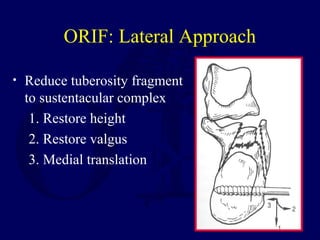 ORIF: Lateral Approach
• Reduce tuberosity fragment
to sustentacular complex
1. Restore height
2. Restore valgus
3. Medial translation
 