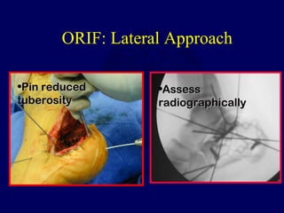 ORIF: Lateral Approach
•Pin reducedPin reduced
tuberositytuberosity
•AssessAssess
radiographicallyradiographically
 