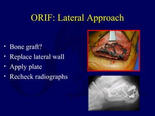 ORIF: Lateral Approach
• Bone graft?
• Replace lateral wall
• Apply plate
• Recheck radiographs
 