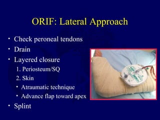 ORIF: Lateral Approach
• Check peroneal tendons
• Drain
• Layered closure
1. Periosteum/SQ
2. Skin
• Atraumatic technique
• Advance flap toward apex
• Splint
 