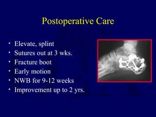 Postoperative Care
• Elevate, splint
• Sutures out at 3 wks.
• Fracture boot
• Early motion
• NWB for 9-12 weeks
• Improvement up to 2 yrs.
 
