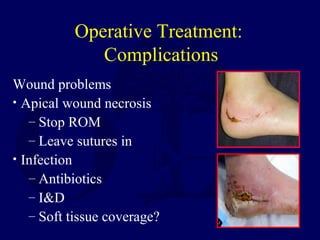 Operative Treatment:
Complications
Wound problems
• Apical wound necrosis
– Stop ROM
– Leave sutures in
• Infection
– Antibiotics
– I&D
– Soft tissue coverage?
 