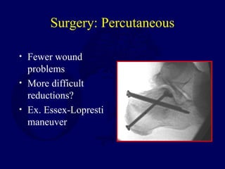 Surgery: Percutaneous
• Fewer wound
problems
• More difficult
reductions?
• Ex. Essex-Lopresti
maneuver
 