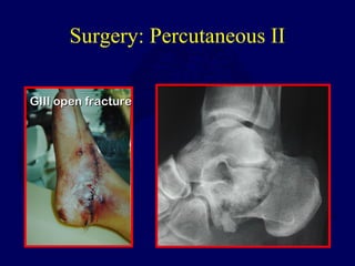 GIII open fractureGIII open fracture
Surgery: Percutaneous II
 
