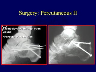 Surgery: Percutaneous II
• Joint elevated through openJoint elevated through open
woundwound
• Percutaneous fixationPercutaneous fixation
 