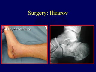 Surgery: Ilizarov
GIII open fractureGIII open fracture
 