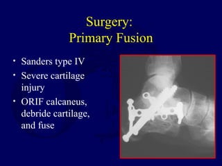 Surgery:
Primary Fusion
• Sanders type IV
• Severe cartilage
injury
• ORIF calcaneus,
debride cartilage,
and fuse
 