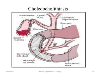Choledocholithiasis
13/05/2023 MUHAS, Department of Surgery 23
 
