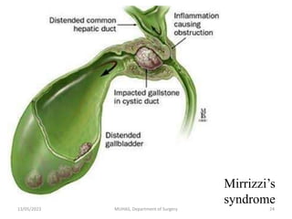 Mirrizzi’s
syndrome
13/05/2023 MUHAS, Department of Surgery 24
 
