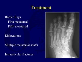 Treatment
Border Rays
First metatarsal
Fifth metatarsal
Dislocations
Multiple metatarsal shafts
Intraarticular fractures
 