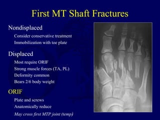First MT Shaft Fractures
Nondisplaced
Consider conservative treatment
Immobilization with toe plate
Displaced
Most require ORIF
Strong muscle forces (TA, PL)
Deformity common
Bears 2/6 body weight
ORIF
Plate and screws
Anatomically reduce
May cross first MTP joint (temp)
 