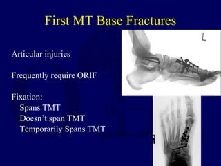 Articular injuries
Frequently require ORIF
Fixation:
Spans TMT
Doesn’t span TMT
Temporarily Spans TMT
First MT Base Fractures
 