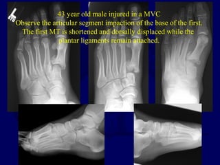 43 year old male injured in a MVC
Observe the articular segment impaction of the base of the first.
The first MT is shortened and dorsally displaced while the
plantar ligaments remain attached.
 