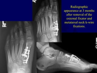 Radiographic
appearance at 3 months
after removal of the
external fixator and
metatarsal neck k-wire
fixations.
 