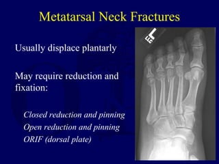 Usually displace plantarly
May require reduction and
fixation:
Closed reduction and pinning
Open reduction and pinning
ORIF (dorsal plate)
Metatarsal Neck Fractures
 