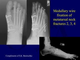 Medullary wire
fixation of
metatarsal neck
fractures 2, 3, 4
Compliments of S.K. Benirschke
 