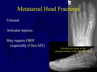 Unusual
Articular injuries
May require ORIF
(especially if first MT)
Metatarsal Head Fractures
Circular saw injury to the
articular surface of the first MT head
 