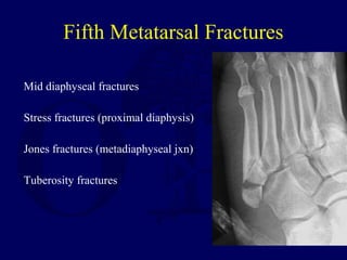 Fifth Metatarsal Fractures
Mid diaphyseal fractures
Stress fractures (proximal diaphysis)
Jones fractures (metadiaphyseal jxn)
Tuberosity fractures
 
