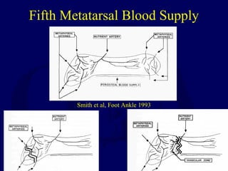 Fifth Metatarsal Blood Supply
Smith et al, Foot Ankle 1993
 