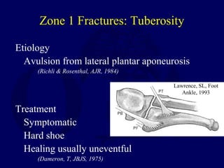 Zone 1 Fractures: Tuberosity
Etiology
Avulsion from lateral plantar aponeurosis
(Richli & Rosenthal, AJR, 1984)
Treatment
Symptomatic
Hard shoe
Healing usually uneventful
(Dameron, T, JBJS, 1975)
Lawrence, SL, Foot
Ankle, 1993
 