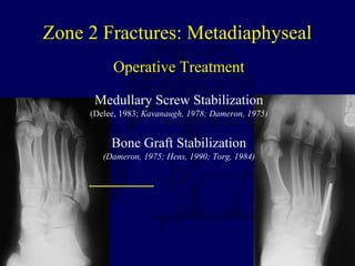 Operative Treatment
Medullary Screw Stabilization
(Delee, 1983; Kavanaugh, 1978; Dameron, 1975)
Bone Graft Stabilization
(Dameron, 1975; Hens, 1990; Torg, 1984)
Zone 2 Fractures: Metadiaphyseal
 