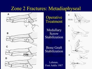 Zone 2 Fractures: Metadiaphyseal
Operative
Treatment
Medullary
Screw
Stabilization
Bone Graft
Stabilization
Lehman,
Foot Ankle 1987
 