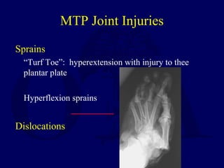MTP Joint Injuries
Sprains
“Turf Toe”: hyperextension with injury to thee
plantar plate
Hyperflexion sprains
Dislocations
 