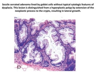 L17 neoplastic polyps | PPT