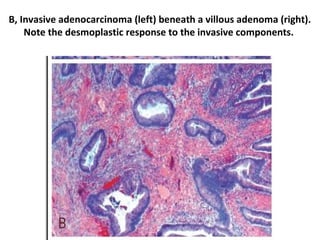 L17 neoplastic polyps | PPT