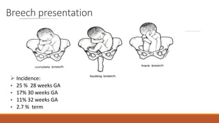 Breech presentation
 Incidence:
• 25 % 28 weeks GA
• 17% 30 weeks GA
• 11% 32 weeks GA
• 2.7 % term
 