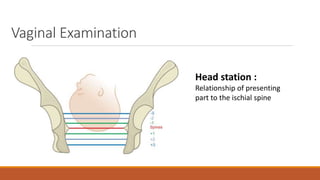 Vaginal Examination
Head station :
Relationship of presenting
part to the ischial spine
 